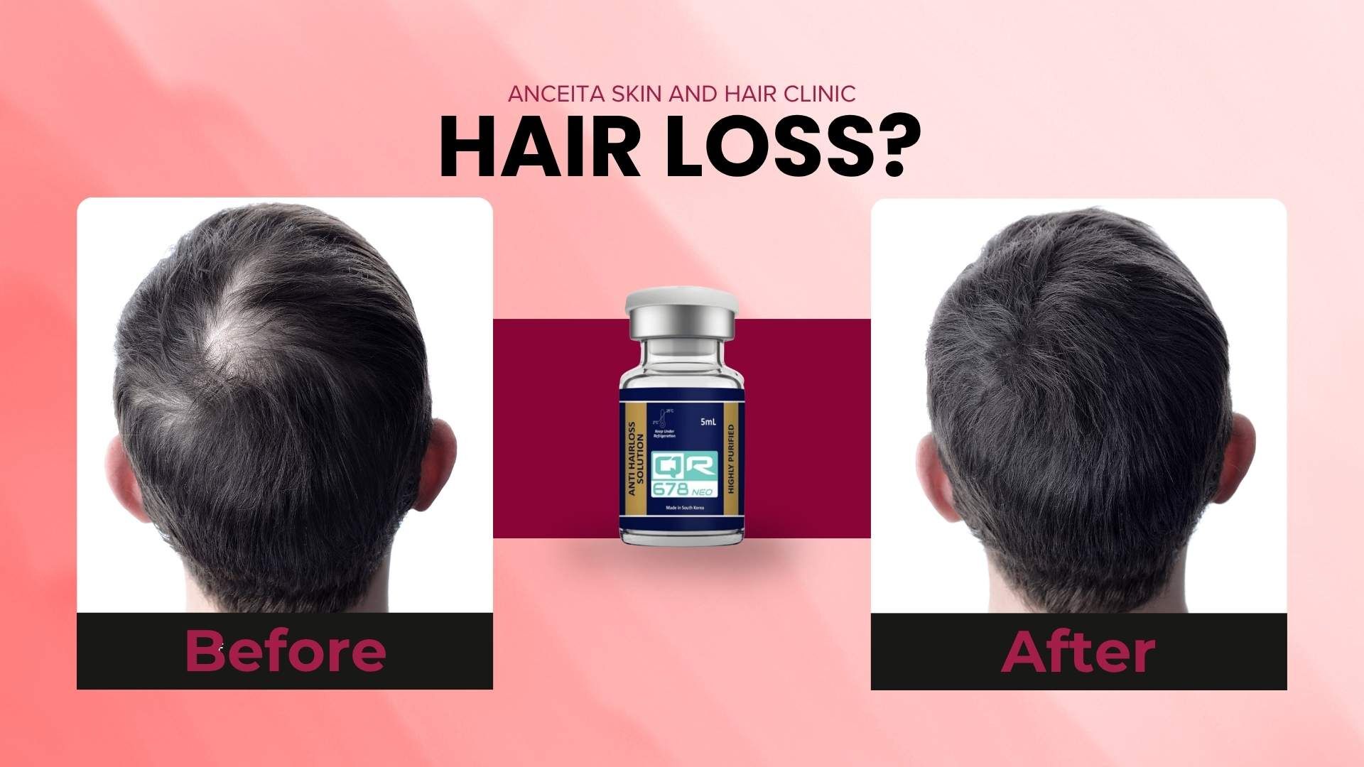 glutathione injection for hair loss QR678 Neo® Treatment in Hyderabad: The Future of Hair Regrowth?